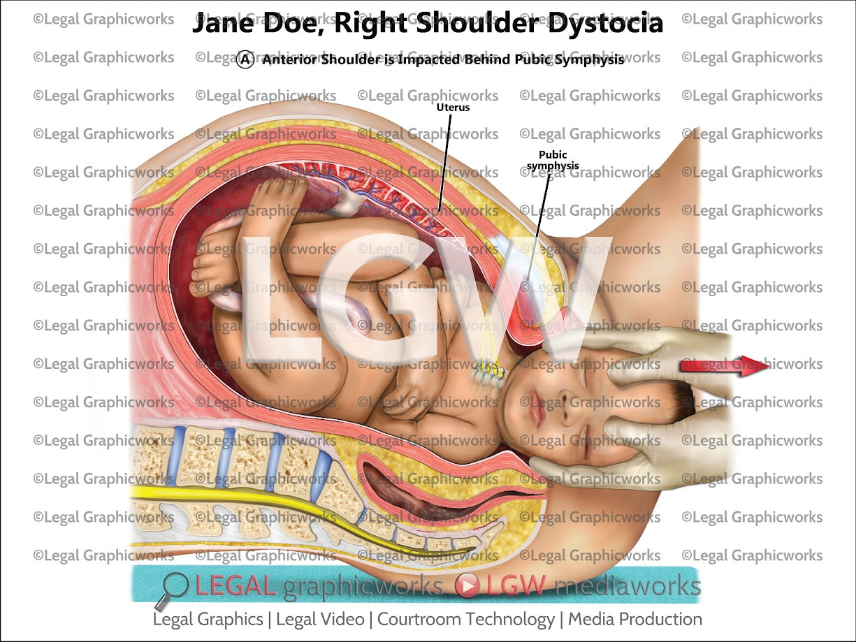 Right Shoulder Dystocia