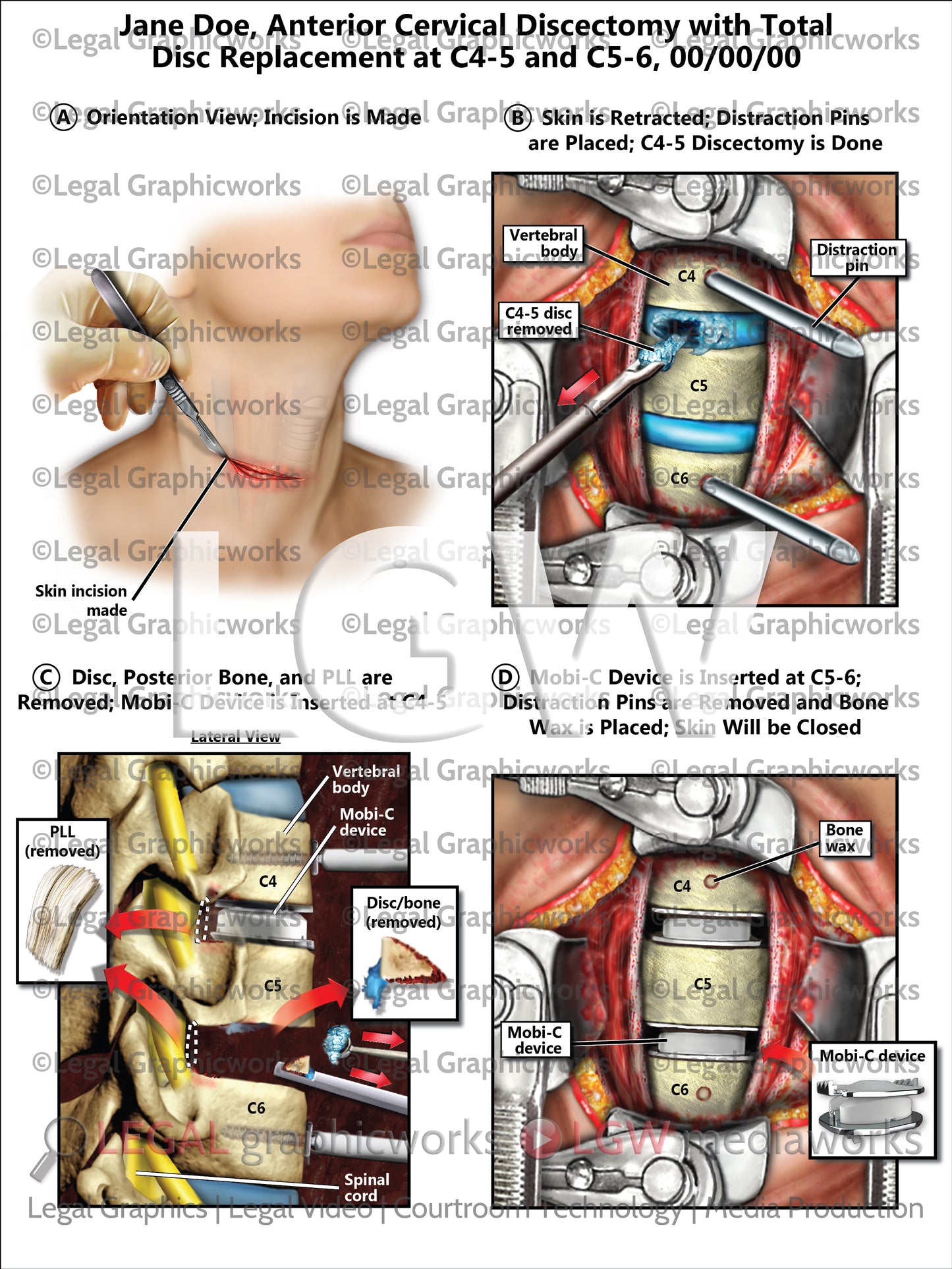 Anterior Cervical Discectomy with Total Disc Replacement at C4-5 and C5-6