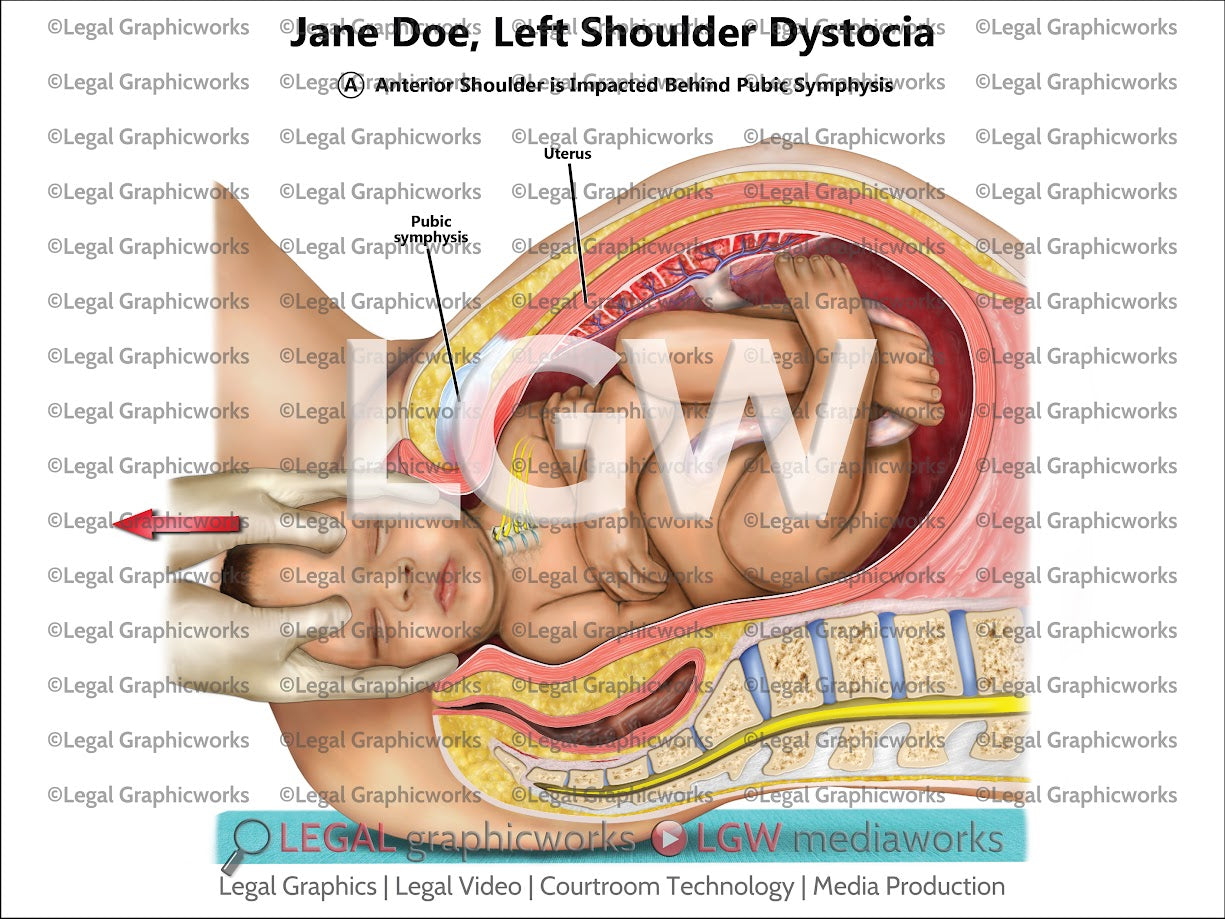 Left Shoulder Dystocia