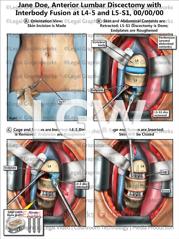 Anterior Lumbar Discectomy with Interbody Fusion at L4-5 and L5-S1