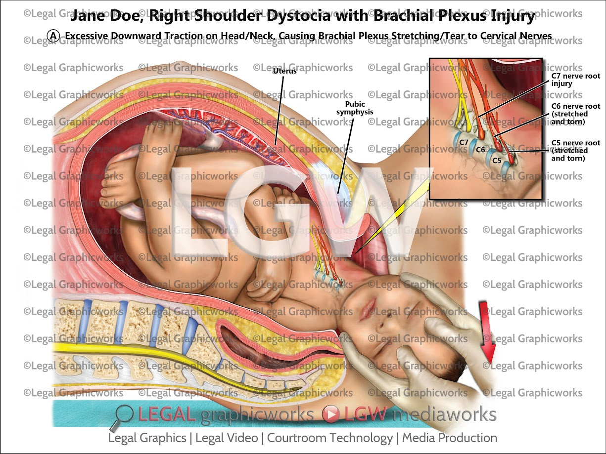 Right Shoulder Dystocia with Brachial Plexus Injury