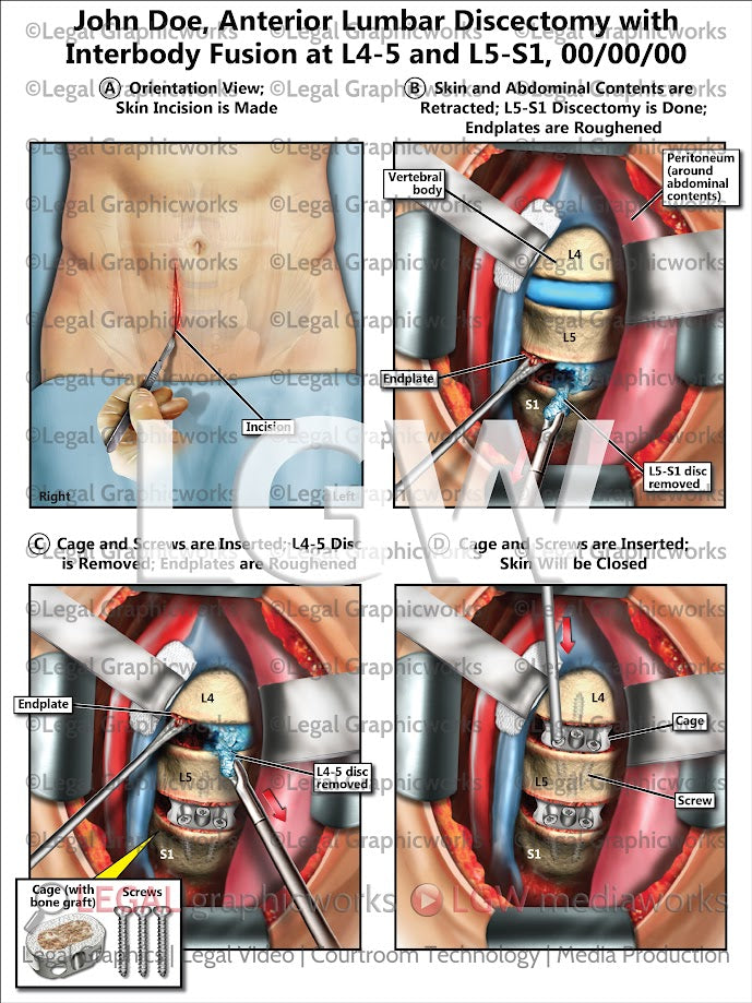 Anterior Lumbar Discectomy with Interbody Fusion at L4-5 and L5-S1
