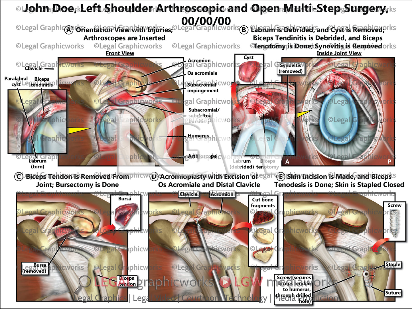 Left Shoulder Arthroscopic and Open Multi-Step Surgery