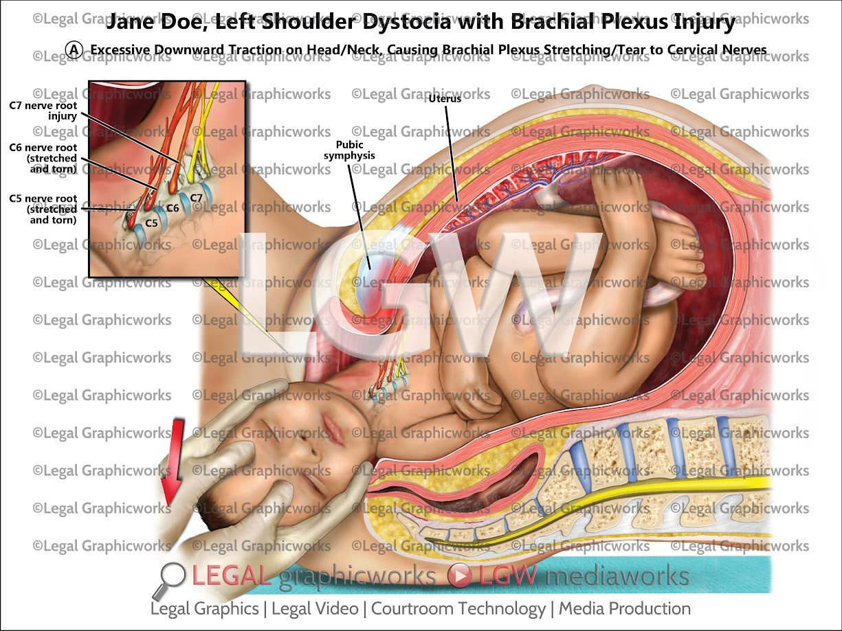 Left Shoulder Dystocia with Brachial Plexus Injury