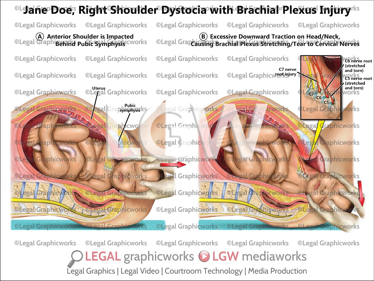 Right Shoulder Dystocia with Brachial Plexus Injury