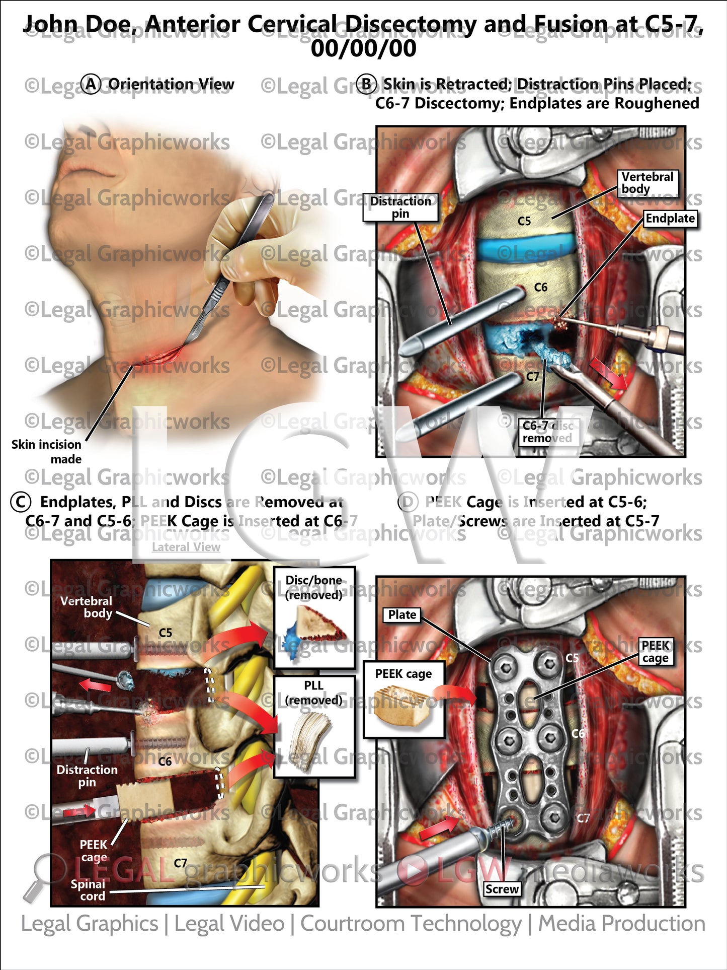 Anterior Cervical Discectomy and Fusion at C5-7