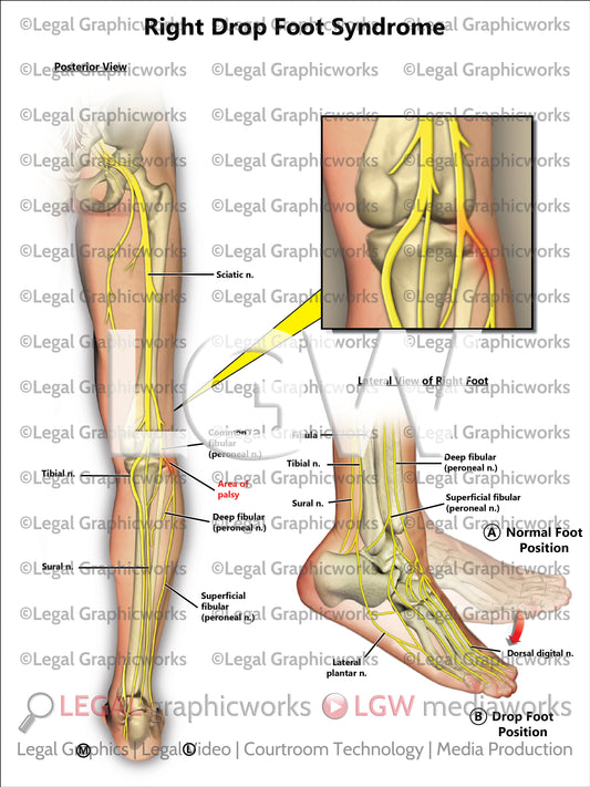Right Drop Foot Syndrome