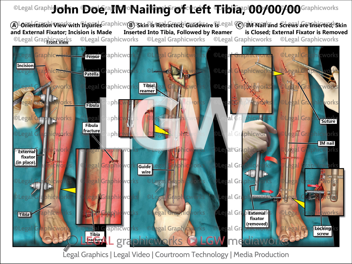 IM Nailing of Left Tibia