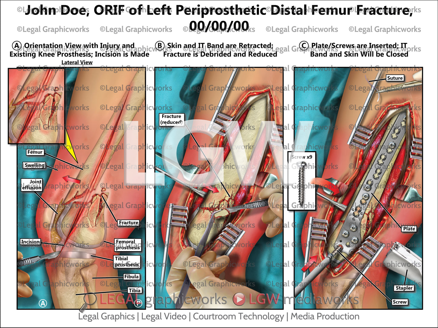 ORIF of Left Periprosthetic Distal Femur Fracture
