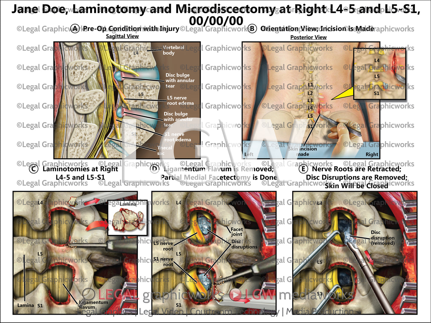 Laminotomy and Microdiscectomy at Right L4-5 and L5-S1