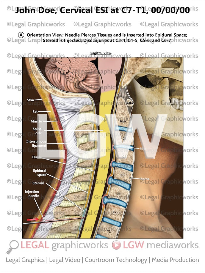 Cervical ESI at C7-T1