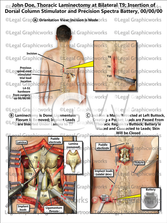 Thoracic Laminectomy at Bilateral T9; Insertion of Dorsal Column Stimulator and Precision Spectra Battery