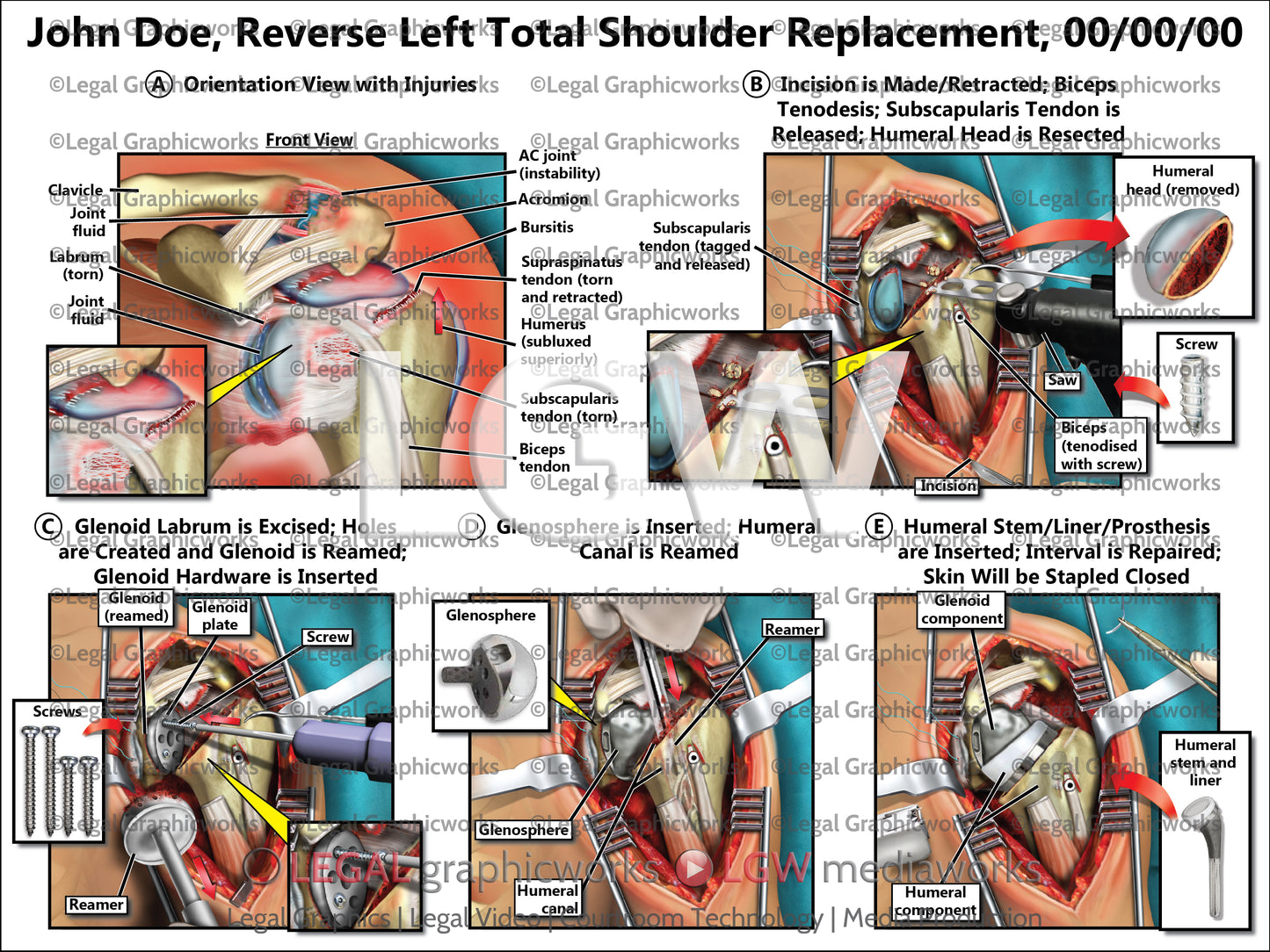 Reverse Left Total Shoulder Replacement