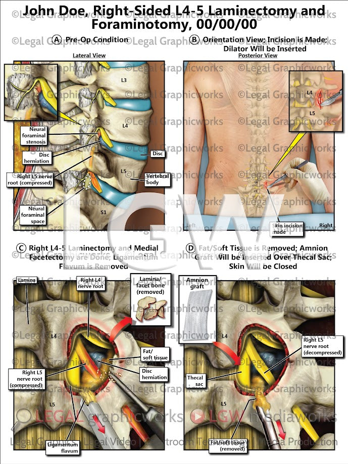 Right-Sided L4-5 Laminectomy and Foraminotomy