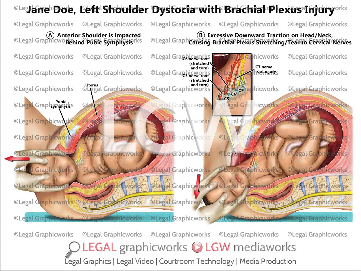 Left Shoulder Dystocia with Brachial Plexus Injury