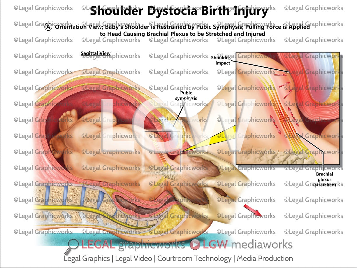 Shoulder Dystocia Birth Injury
