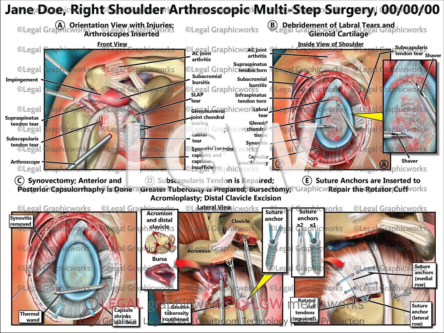 Right Shoulder Arthroscopic Multi-Step Surgery
