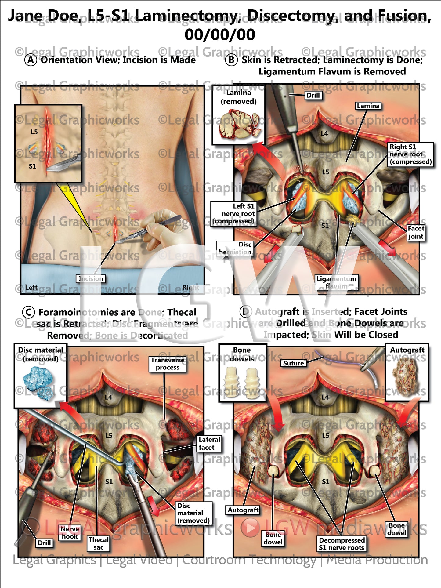 L5-S1 Laminectomy, Discectomy, and Fusion