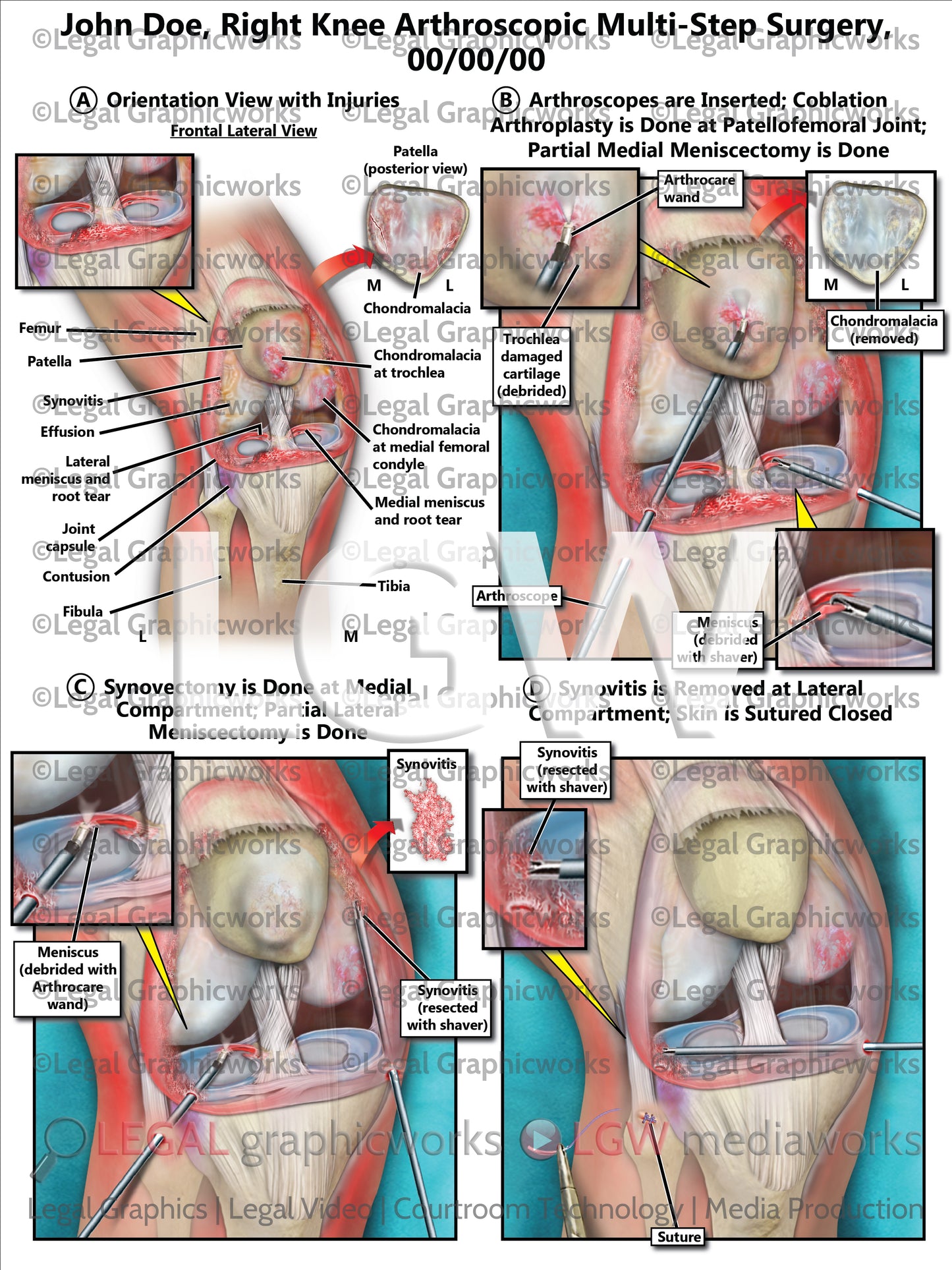 Right Knee Arthroscopic Multi-Step Surgery