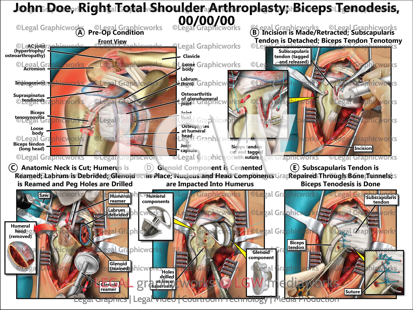 Right Total Shoulder Arthroplasty; Biceps Tenodesis