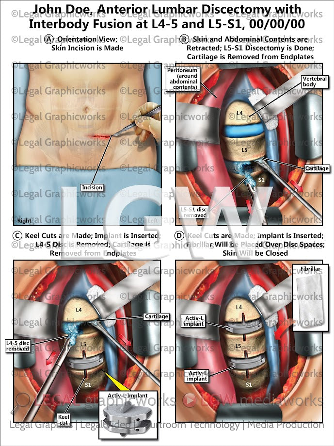 Anterior Lumbar Discectomy with Interbody Fusion at L4-5 and L5-S1