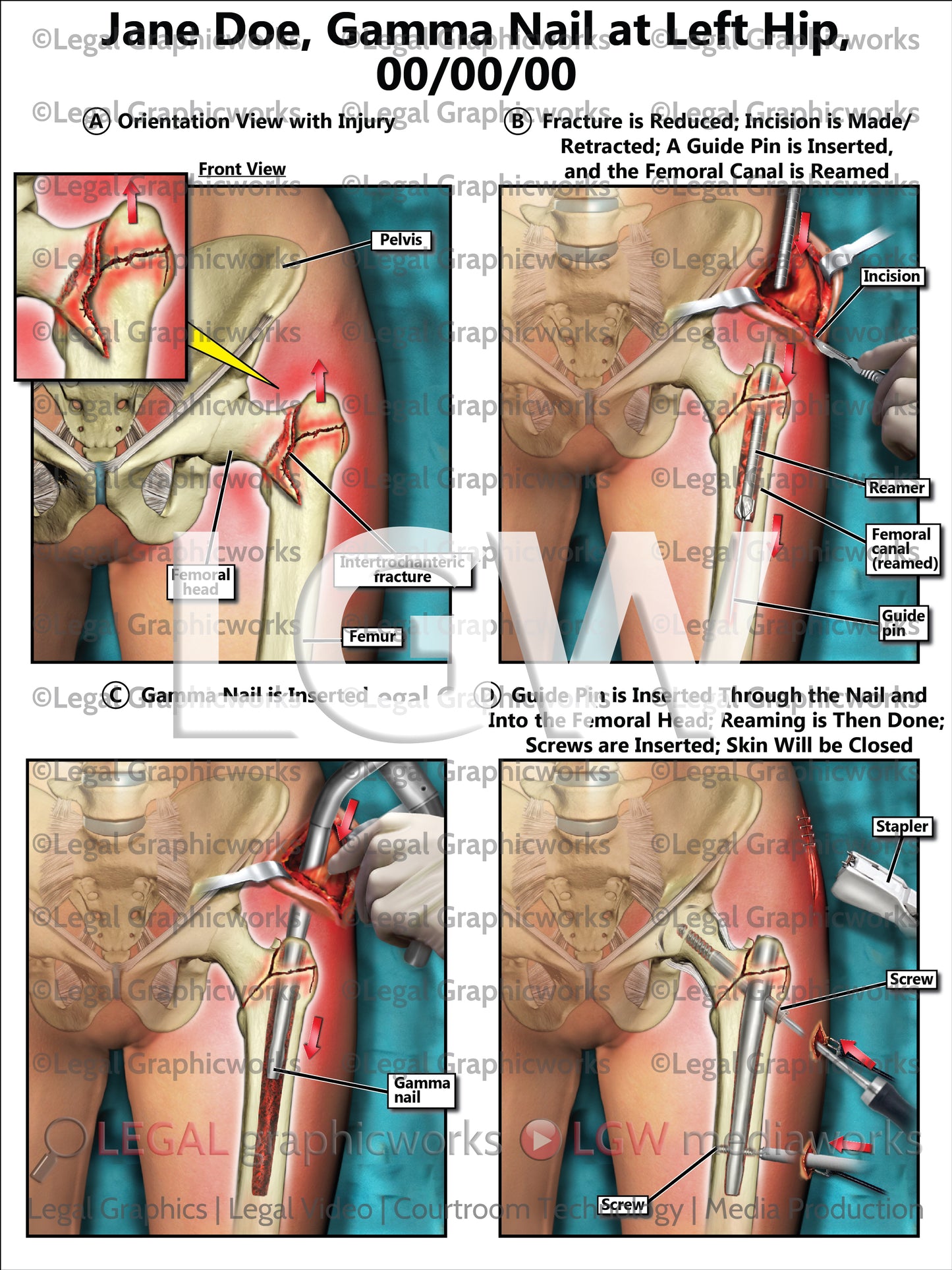 Gamma Nail at Left Hip