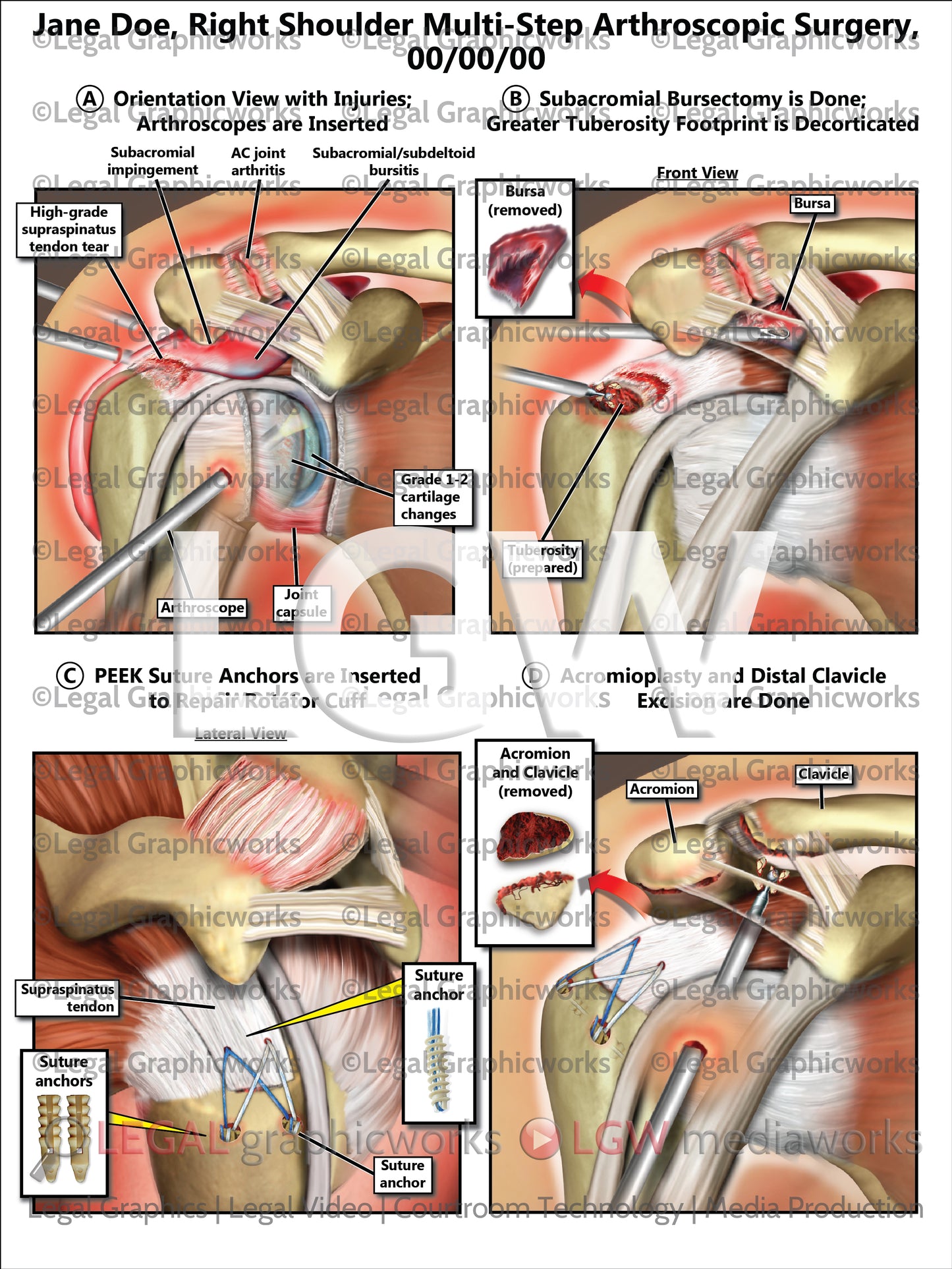 Right Shoulder Multi-Step Arthroscopic Surgery