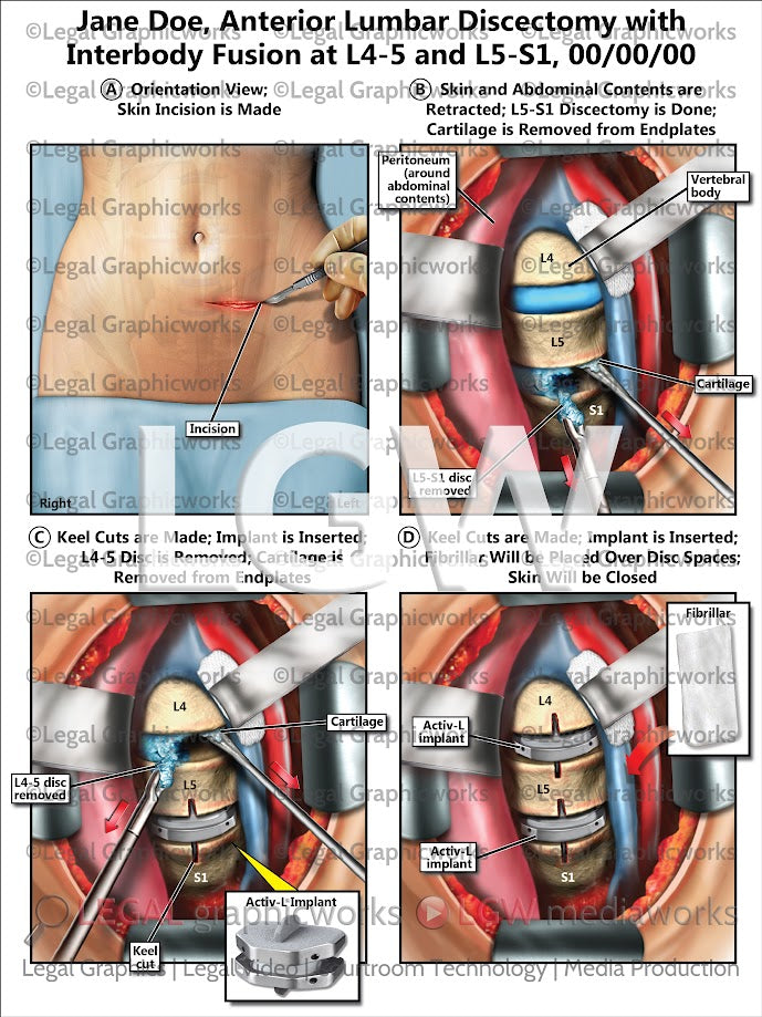 Anterior Lumbar Discectomy with Interbody Fusion at L4-5 and L5-S1