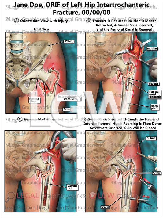 ORIF of Left Hip Intertrochanteric Fracture