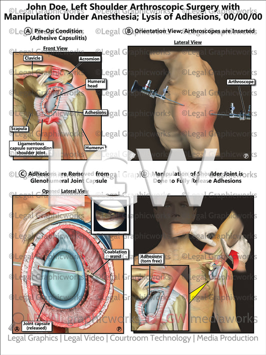 Left Shoulder Arthroscopic Surgery with Manipulation Under Anesthesia; Lysis of Adhesions