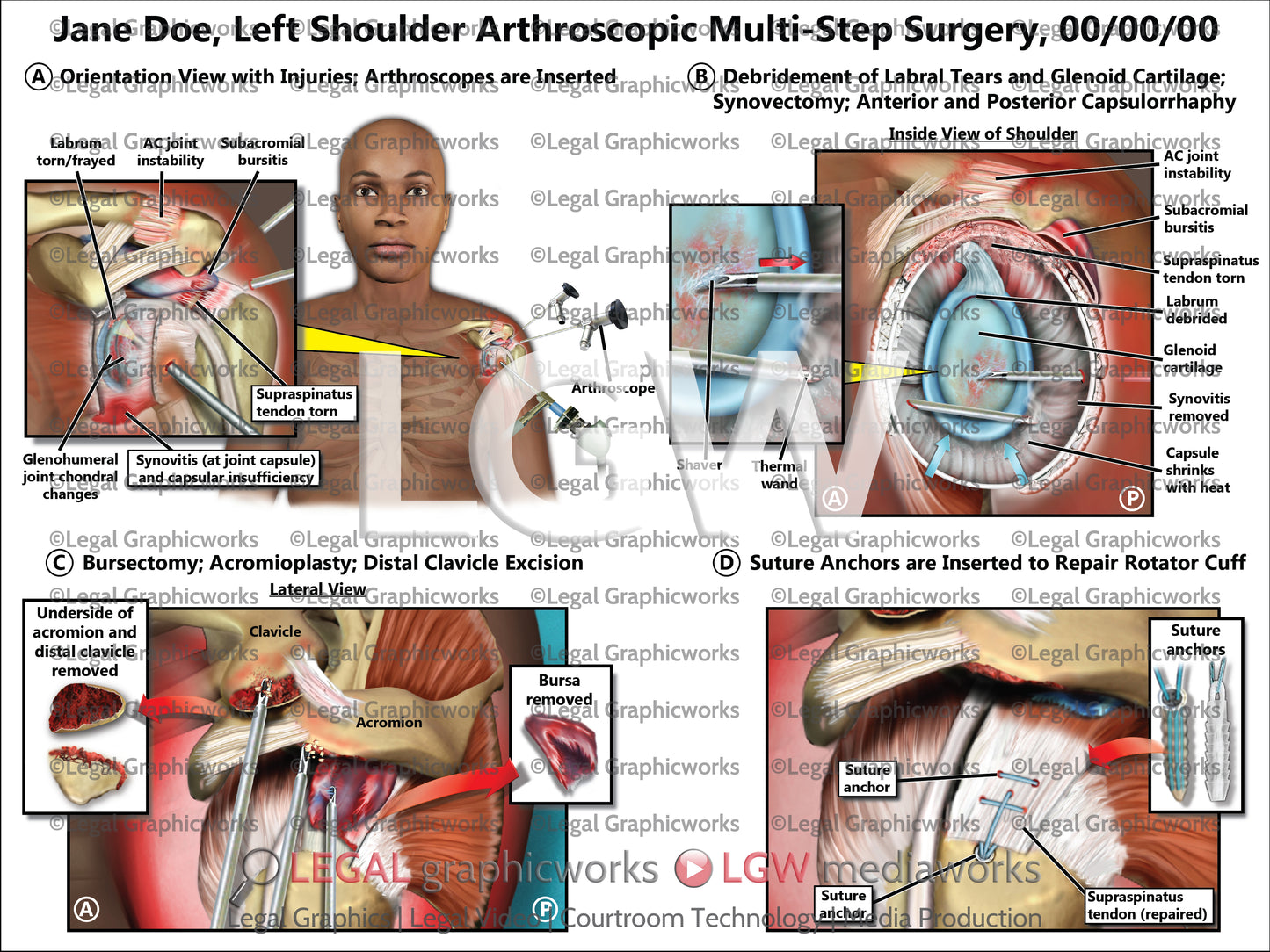 Left Shoulder Arthroscopic Multi-Step Surgery