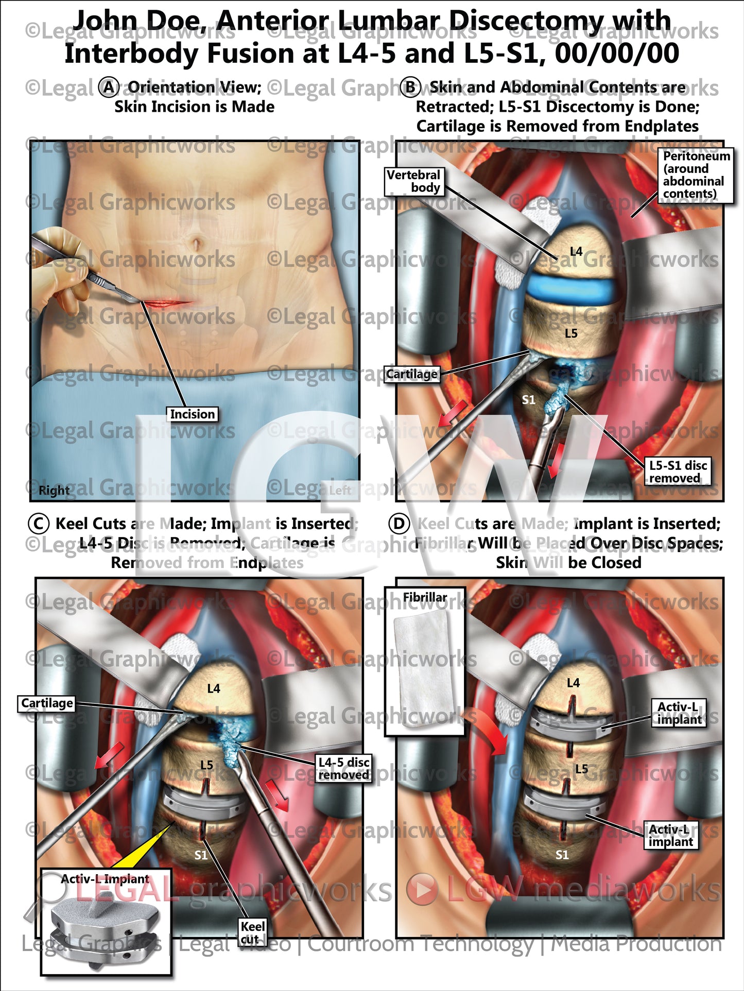 Anterior Lumbar Discectomy with Interbody Fusion at L4-5 and L5-S1