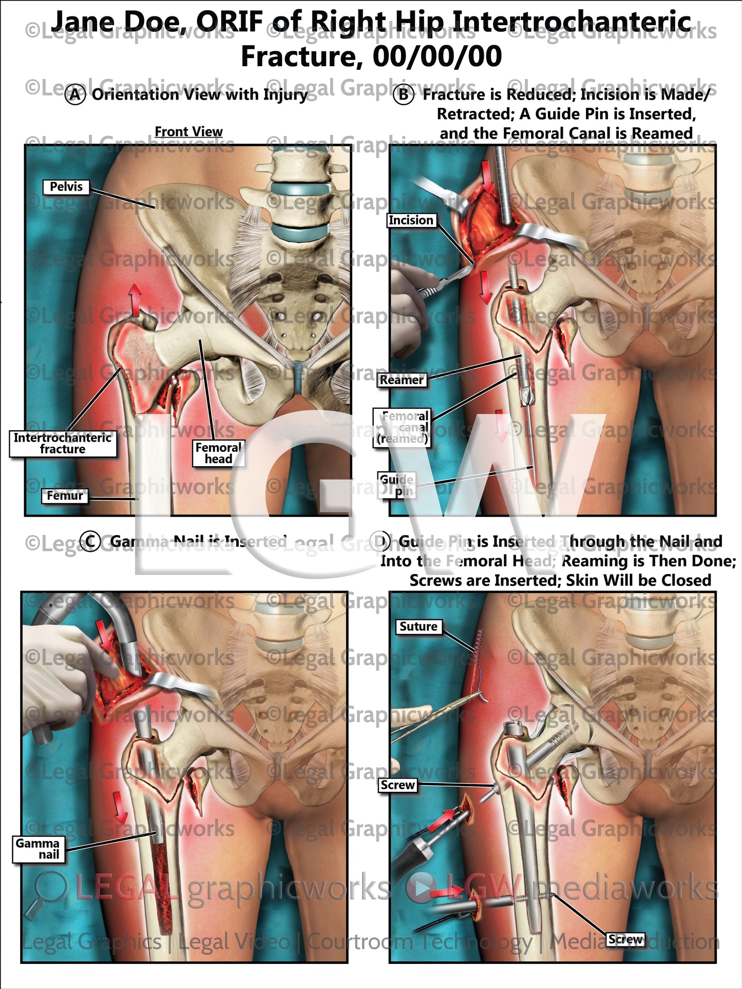 ORIF of Right Hip Intertrochanteric Fracture