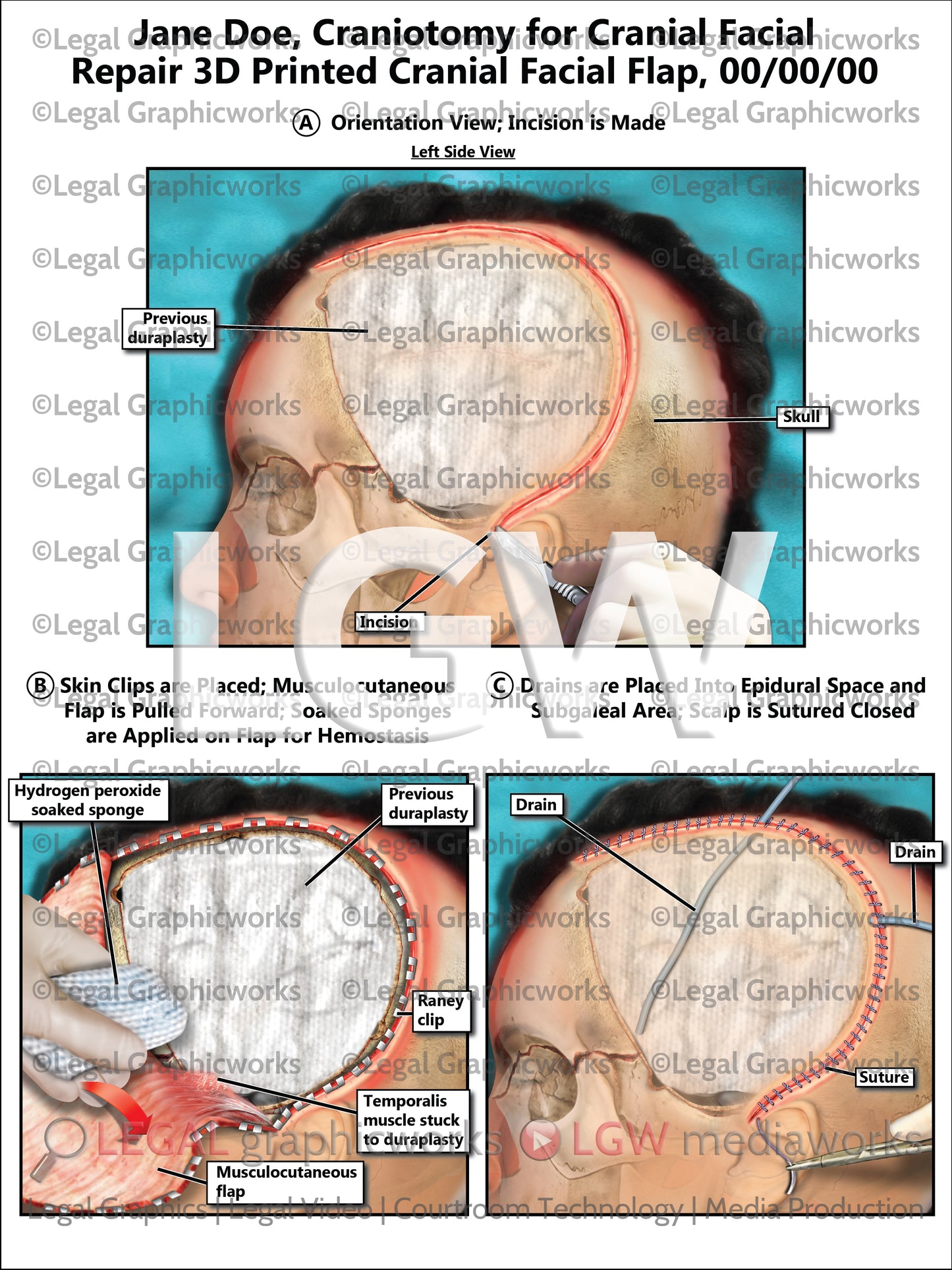 Craniotomy for Cranial Facial Repair 3D Printed Cranial Facial Flap