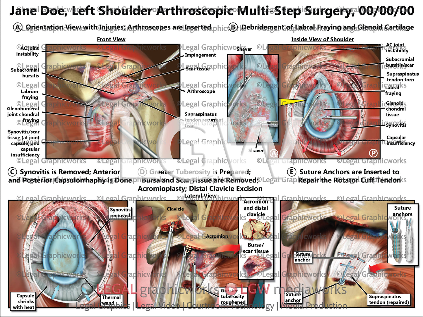 Left Shoulder Arthroscopic Multi-Step Surgery