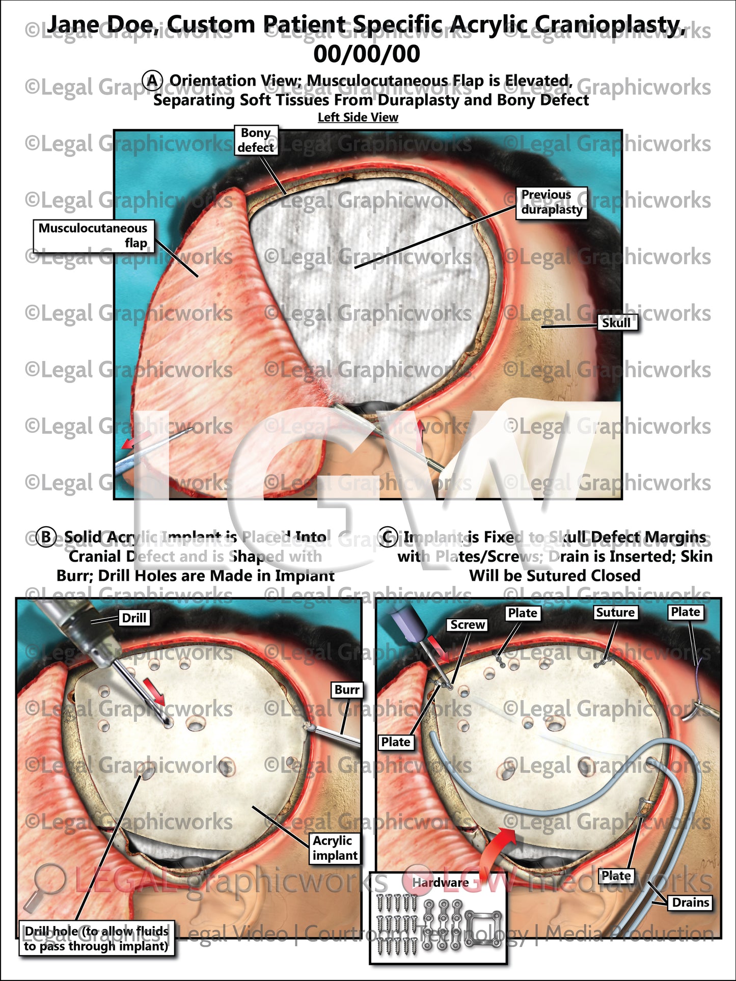 Custom Patient Specific Acrylic Cranioplasty