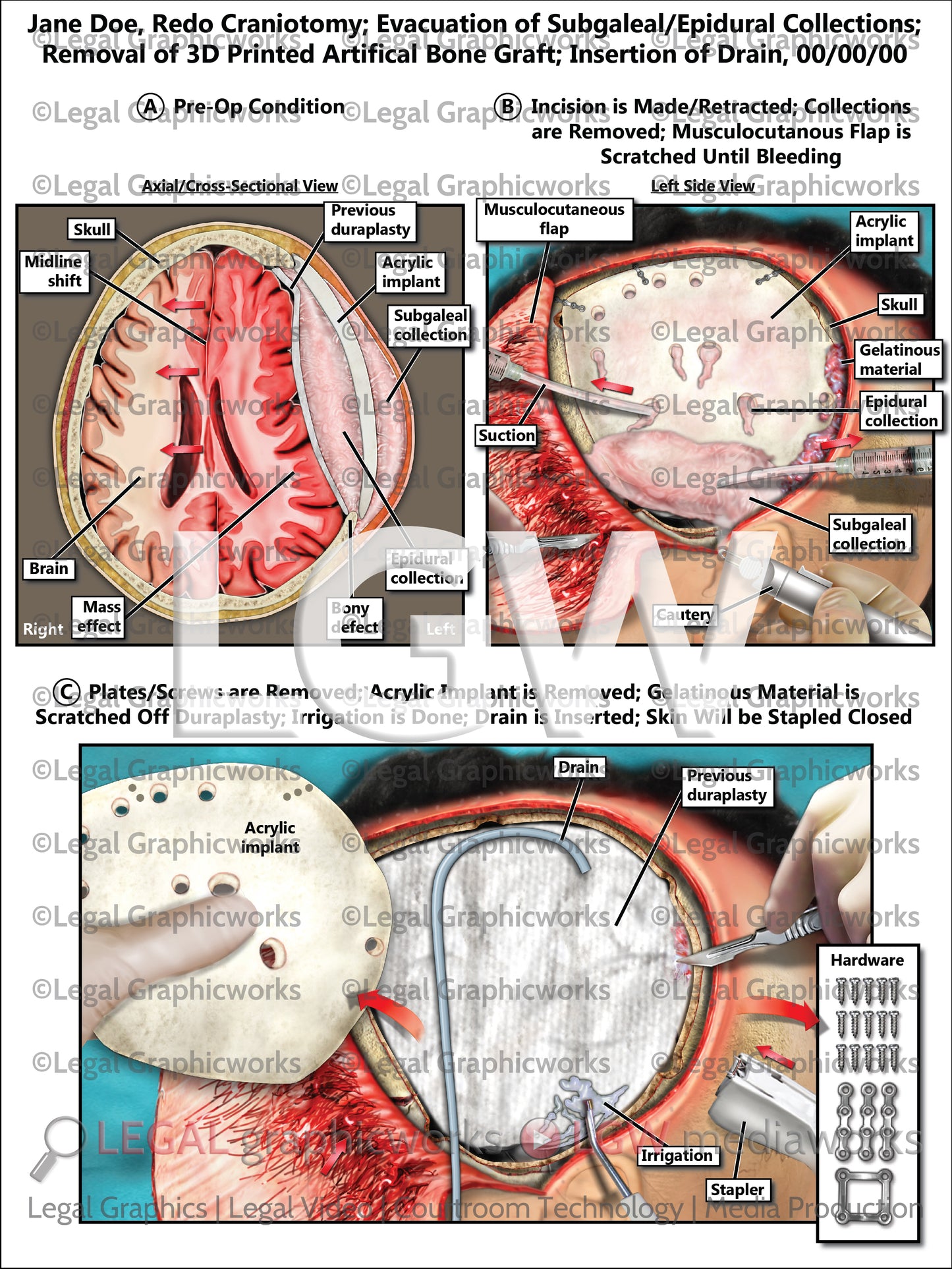 Redo Craniotomy; Evacuation of Subgaleal/Epidural Collections; Removal of 3D Printed Artificial Bone Graft; Insertion of Drain