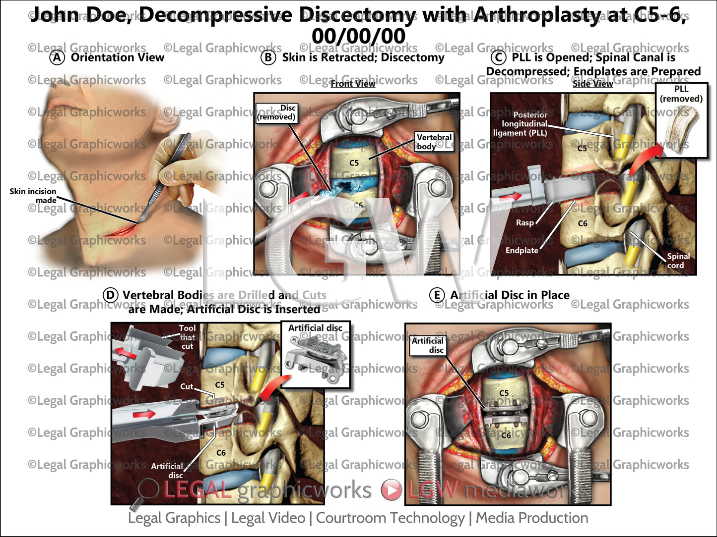 Decompressive Discectomy with Arthroplasty at C5-6