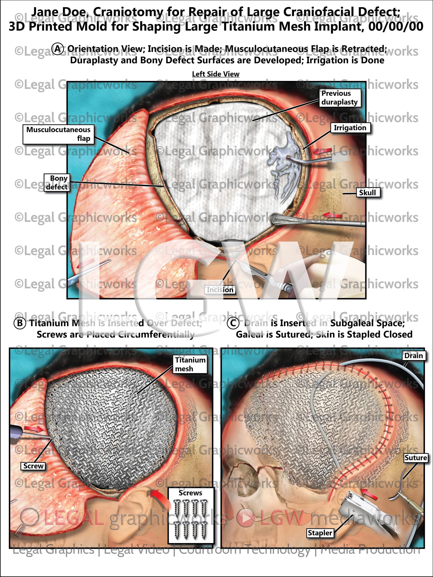 Craniotomy for Repair of Large Craniofacial Defect; 3D Printed Mold for Shaping Large Titanium Mesh Implant