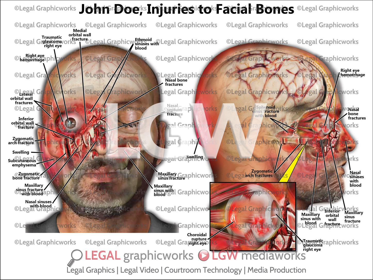 Injuries to Facial Bones