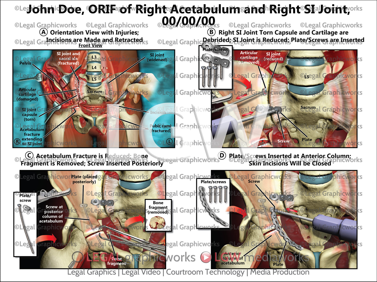 ORIF of Right Acetabulum and Right SI Joint