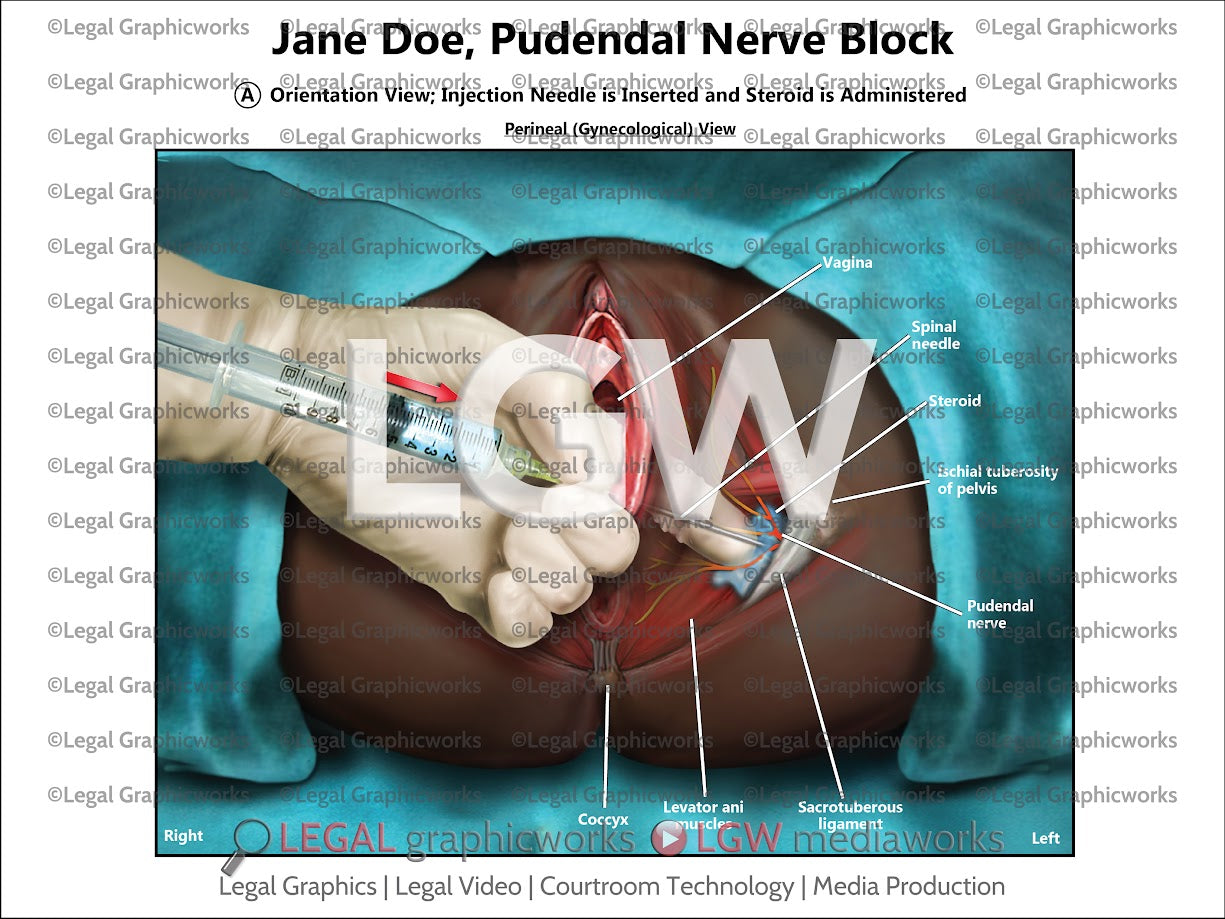Pudendal Nerve Block