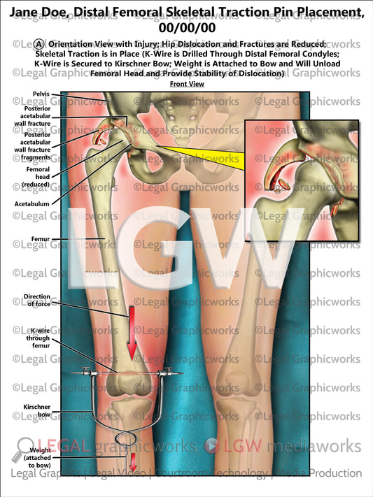 Distal Femoral Skeletal Traction Pin Placement