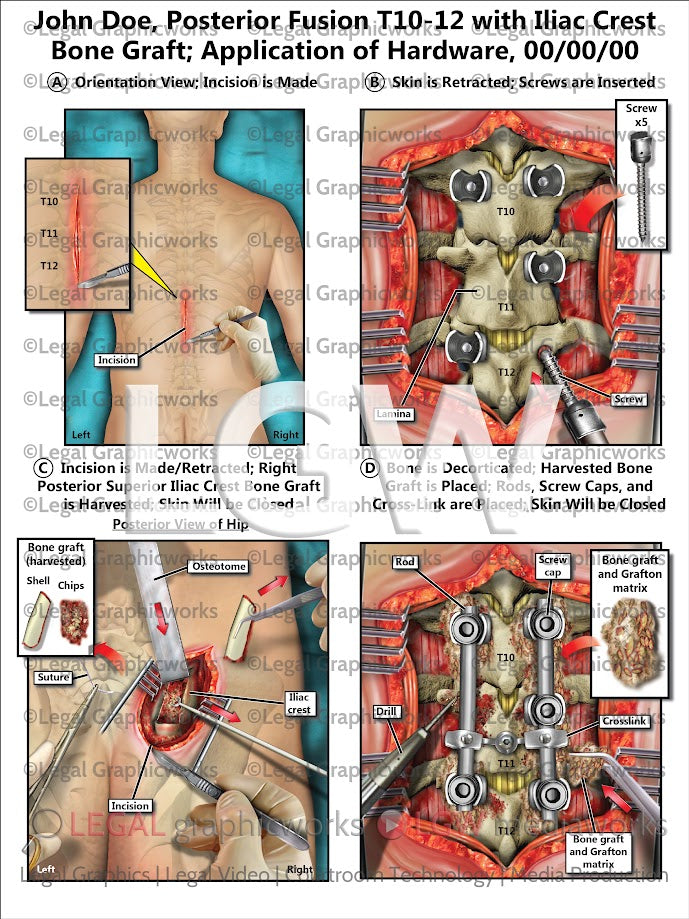 Posterior Fusion T10-12 with Iliac Crest Bone Graft; Application of Hardware