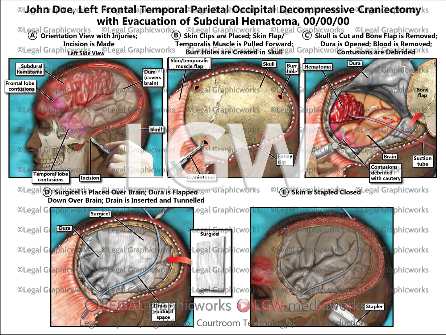 Left Frontal Temporal Parietal Occipital Decompressive Craniectomy with Evacuation of Subdural Hematoma