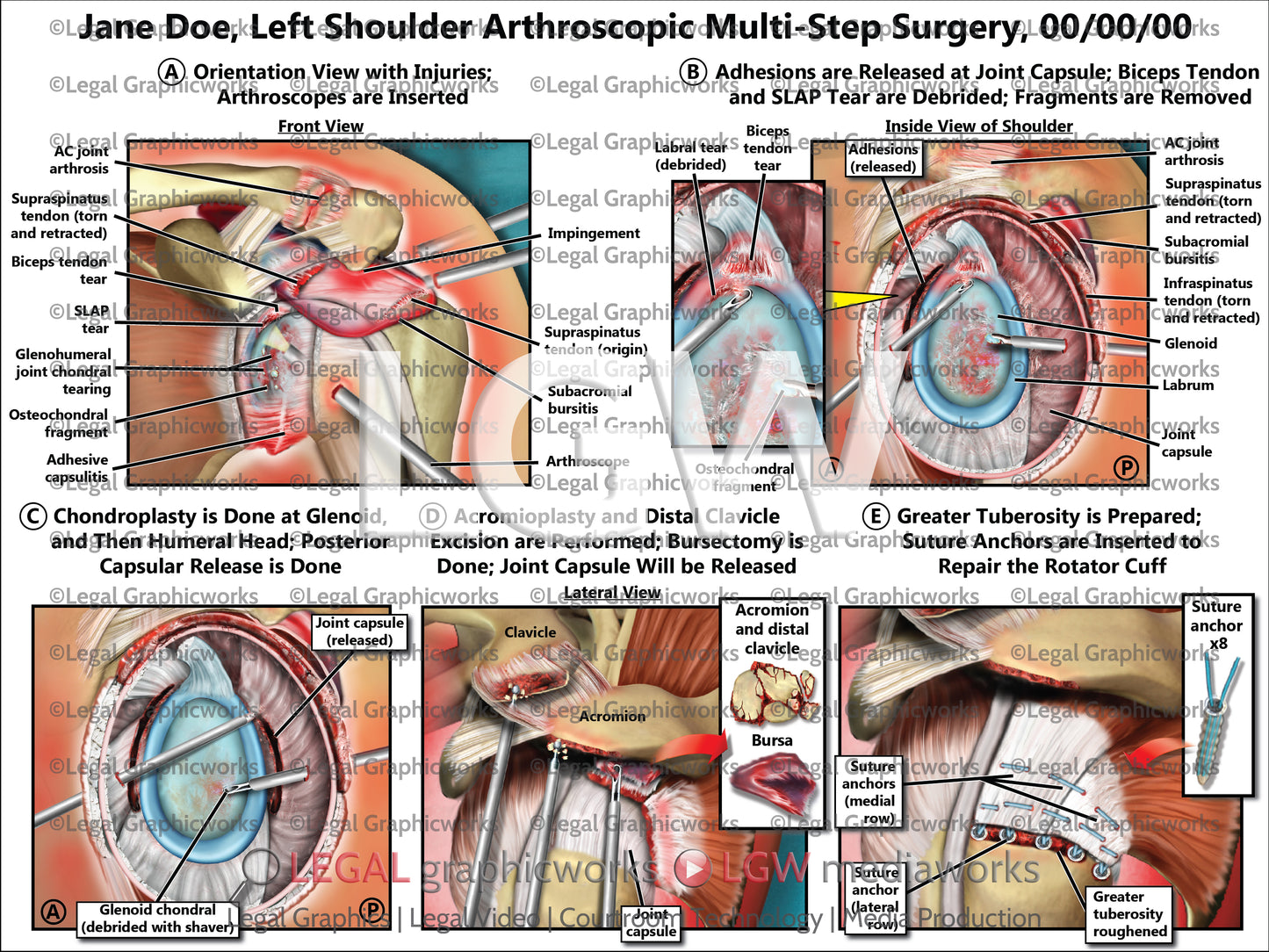 Left Shoulder Arthroscopic Multi-Step Surgery