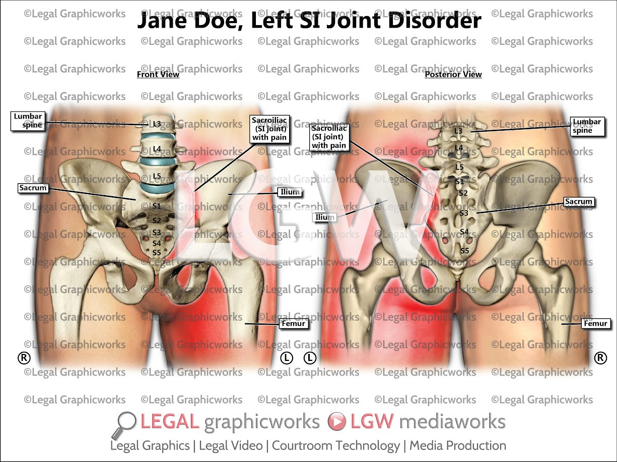 Left SI Joint Disorder