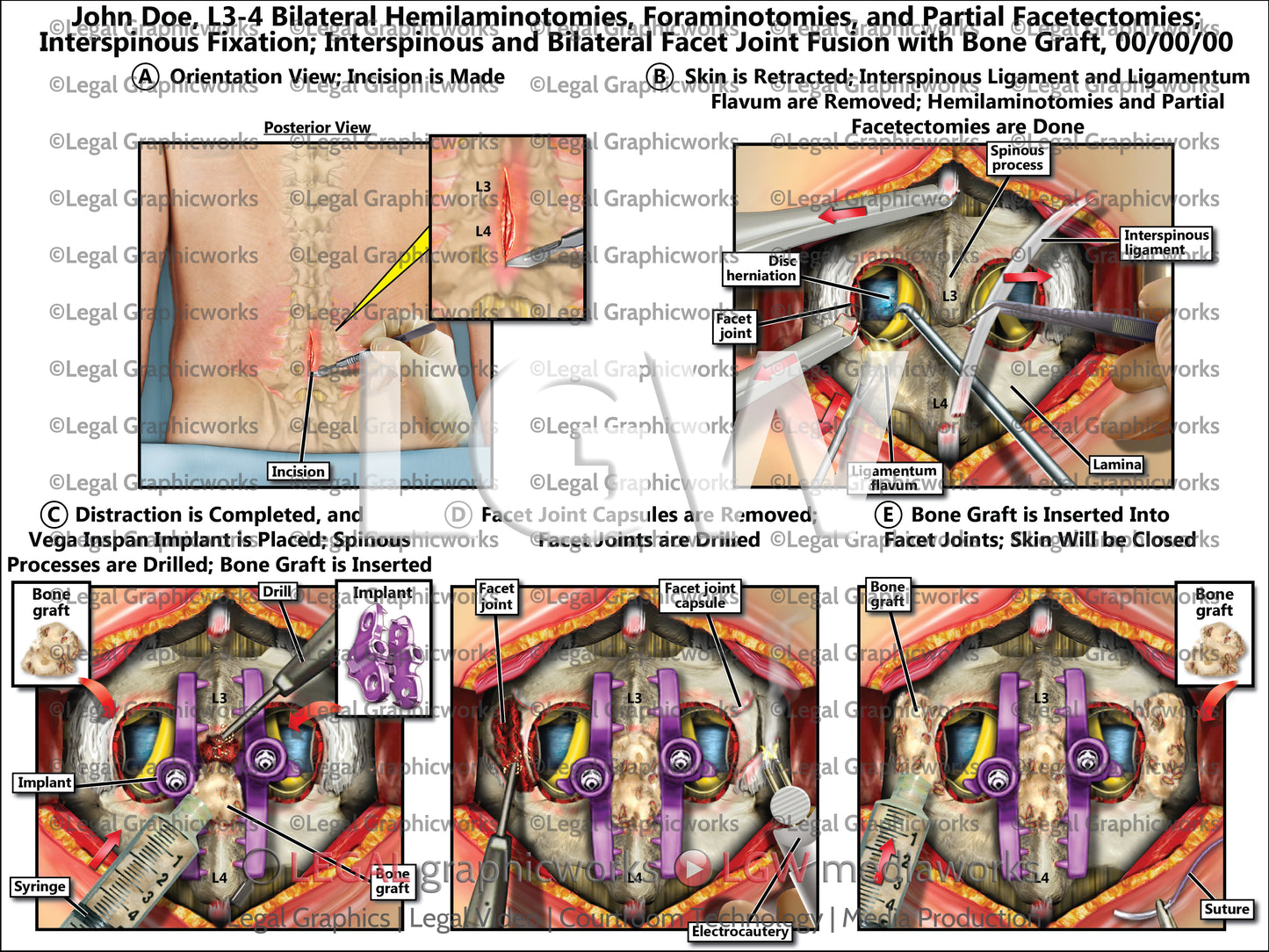 L3-4 Bilateral Hemilaminotomies, Foraminotomies, and Partial Facetectomies; Interspinous Fixation; Interspinous and Bilateral Facet Joint Fusion with Bone Graft