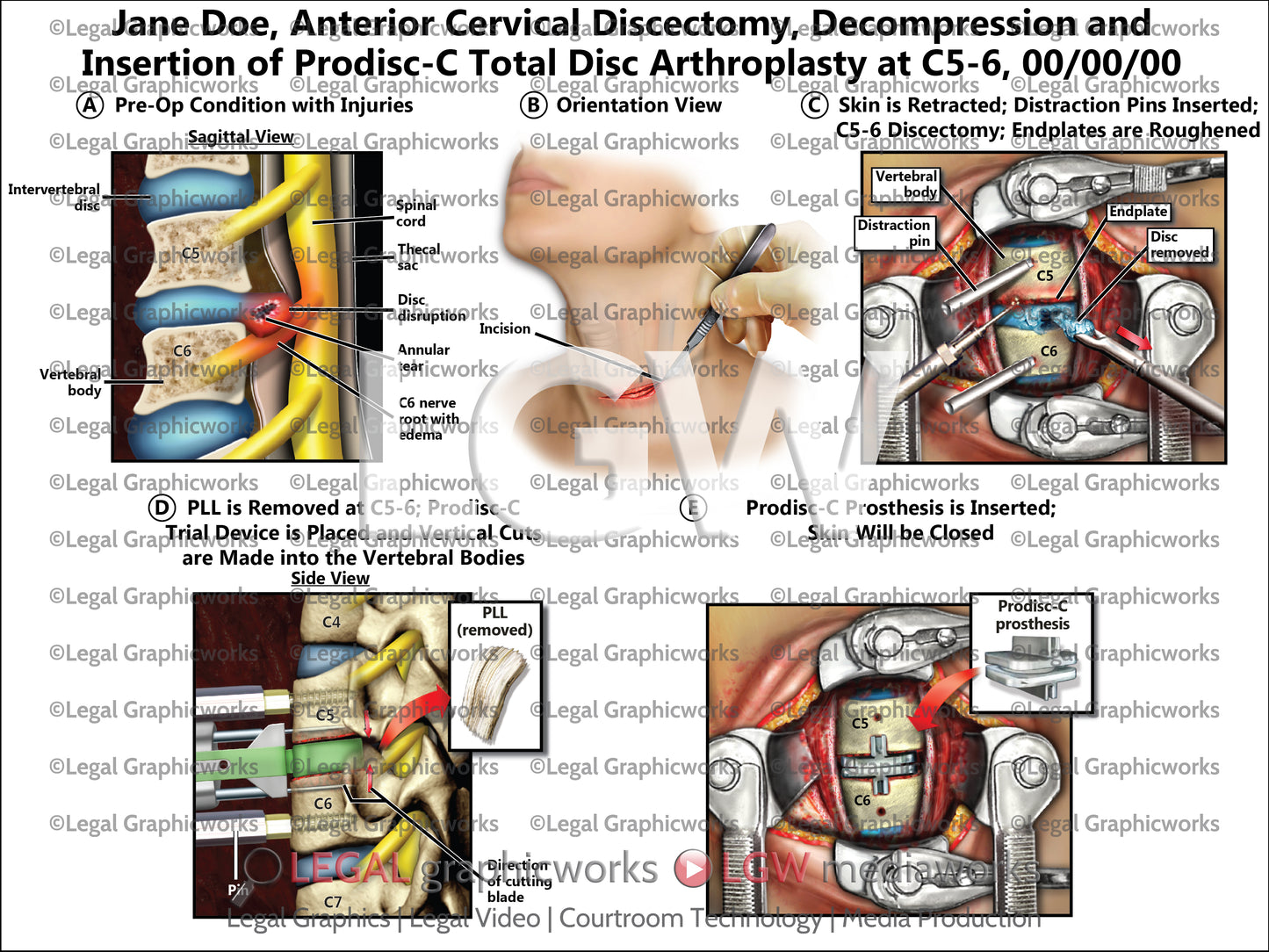 Anterior Cervical Discectomy, Decompression and Insertion of Prodisc-C Total Disc Arthroplasty at C5-6