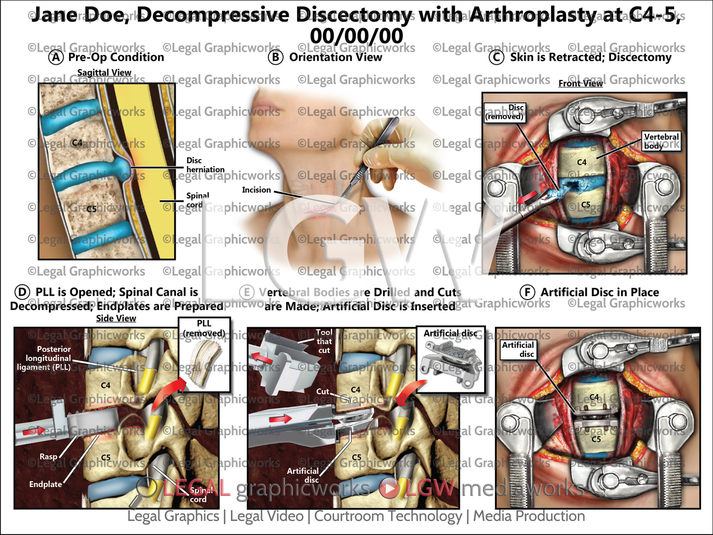 Decompressive Discectomy with Arthroplasty at C4-5